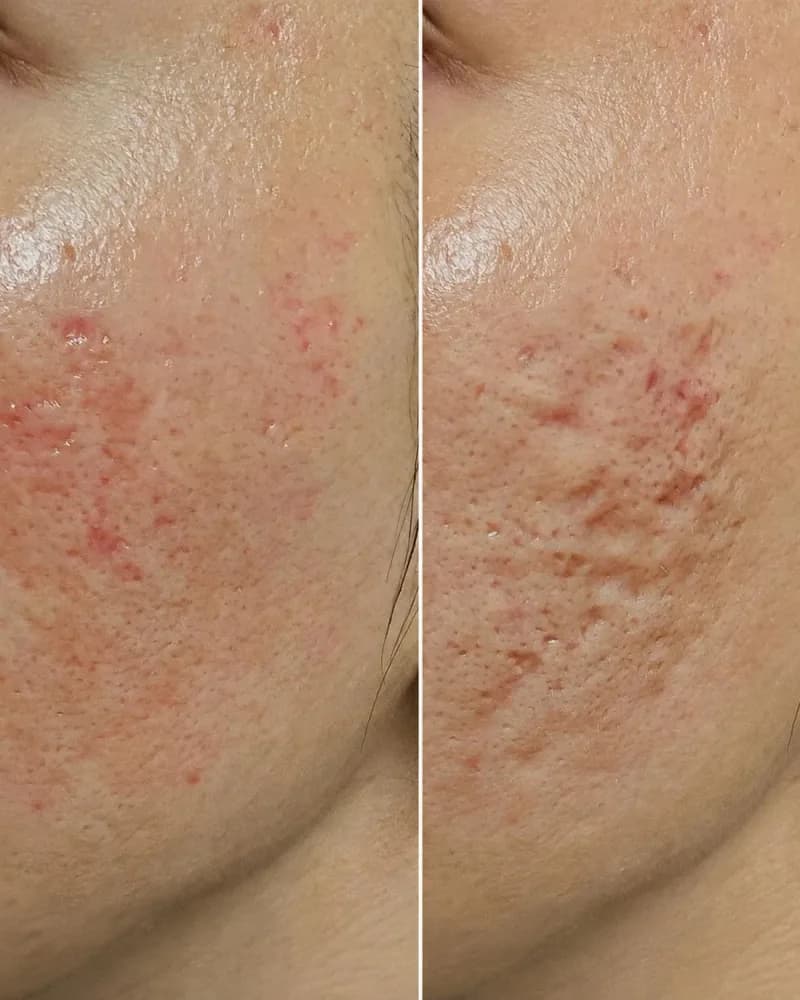 Vorher-Nachher-Vergleich: RF-Microneedling